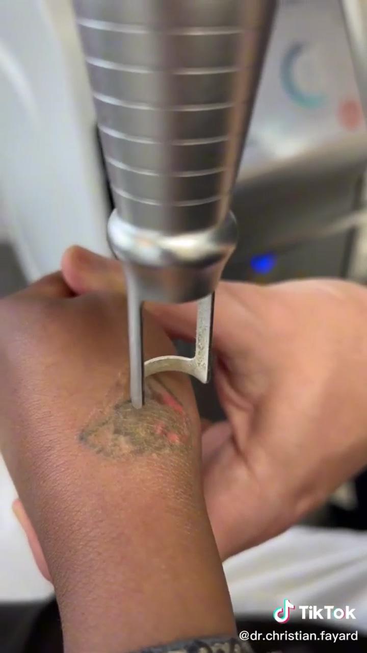 Tattoo removal within 1 min; tips: making long strokes for ink drip #yuelong #emalla #tattootips #tattoolover #tattoo #tattoos
