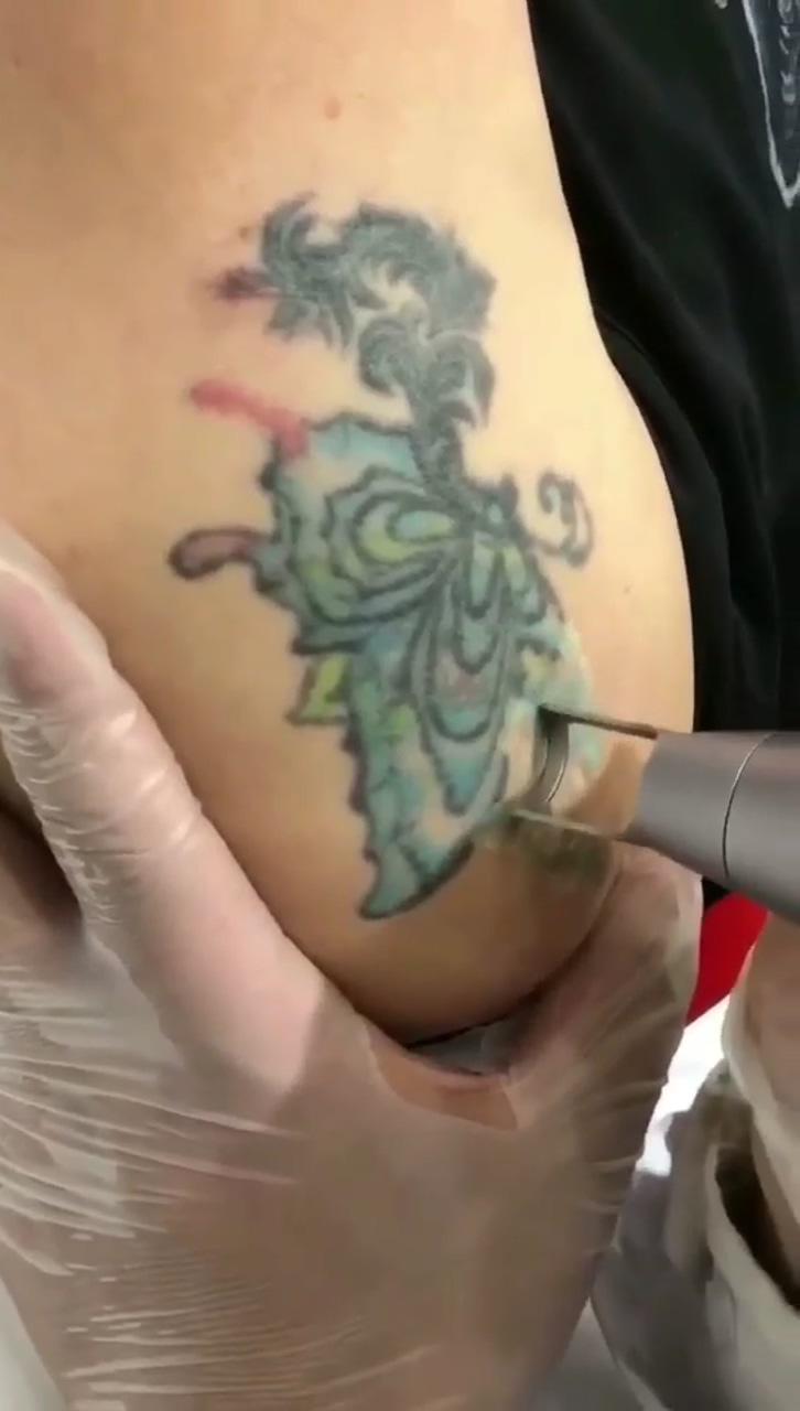 Pico laser tattoo removal; amazing 3d tattoos