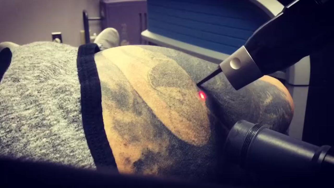 Untattoou: 1st picosure laser tattoo removal [dense black ink]; lip tattoos