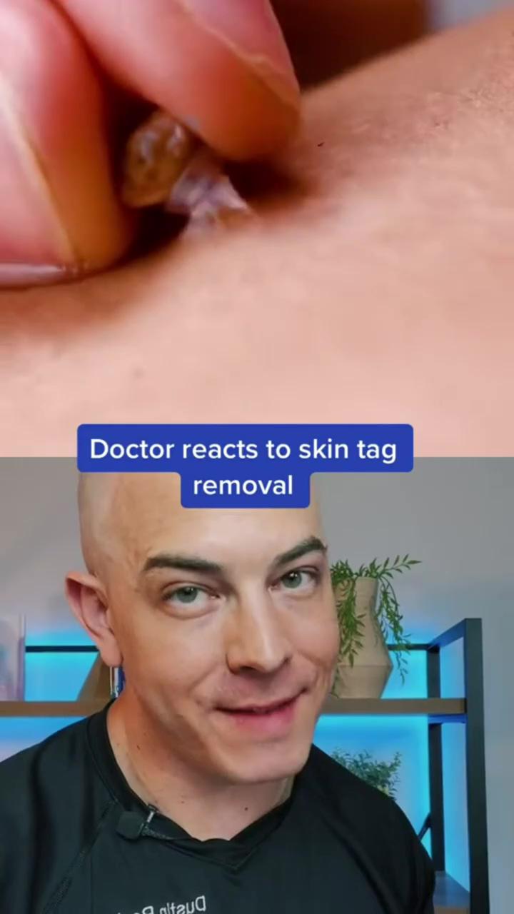 Derm reacts to diy mole removal; i love this vine omg